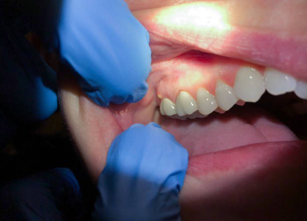 Best Emergency Denture Repair in Sayreville, NJ
